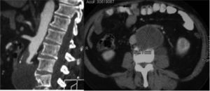 Angio-tomografía axial computarizada: masa englobando aorta con trombosis aórtica distal a renales y erosión de cuerpos vertebrales L3-L4.