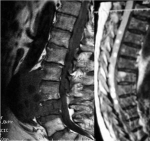 Resonancia magnética nuclear: hidatidosis vertebral lumbar complicada con diseminación aórtica, al espacio prevertebral y canal espinal.