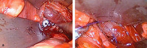 a. Hemorragia secundaria a perforación de vena iliaca primitiva izquierda. b. Reparación de lesión venosa en vena iliaca primitiva izquierda con puntos sueltos de polipropileno.