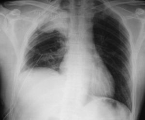 Radiografía de tórax postoperatoria con elevación de hemidiafragma derecho por parálisis de nervio frénico.