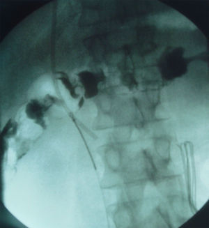 Radiografía intraoperatoria que demuestra la captura del catéter por el sistema de lazo.