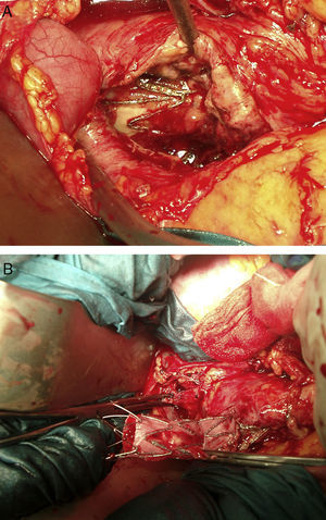 Imágenes quirúrgicas. A. Saco aneurismático parcialmente abierto, endoprótesis en su interior. Presencia de contenido biliar. B. Aorta infrarrenal pinzada, explantación de la endoprótesis.
