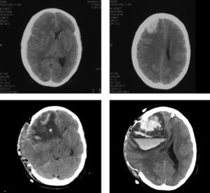 TAC cerebral: hemorragia parenquimatosa y en espacio subaracnoideo en un caso de SHC severo.