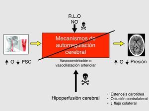 Alteración de los mecanismos de autorregulación cerebral en el SHC (mecanismo fisiopatológico). FSC: flujo sanguíneo cerebral; NO: óxido nítrico; R.L.O: radicales libres de oxígeno.