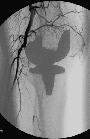 Arteriografía intraoperatoria con trombosis de la segunda porción de la arteria poplítea con permeabilidad a partir de tercera porción de la misma.