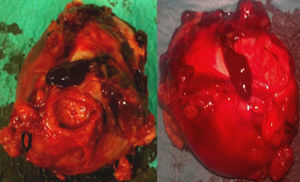 Aneurisma arteria esplénica (pieza quirúrgica).