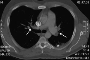TC helicoidal. Se observan defectos de repleción en las 2 ramas principales de la arteria pulmonar, compatibles con trombosis bilateral masiva del sistema arterial pulmonar (flechas). También se ve una pequeña condensación de morfología triangular y base periférica compatible con infarto pulmonar (asterisco).