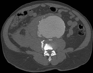 TC abdominopélvica, corte axial: aneurisma de aorta abdominal infrarrenal roto con fístula aortocava.