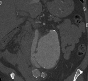 TC abdominopélvica, corte sagital: aneurisma de aorta infrarrenal roto con fístula aortocava.