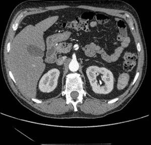 Disección de la arteria mesentérica superior en el paciente 1 (corte axial de la tomografía axial computarizada).