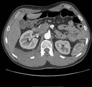 Disección de la arteria mesentérica superior en el paciente 2 (corte axial de la tomografía axial computarizada). Obsérvese también el hematoma retroperitoneal derecho.