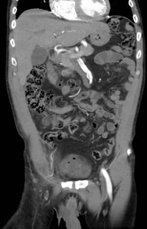Disección de la arteria mesentérica superior (AMS) en el paciente 2 (corte coronal de la tomografía axial computarizada). En esta imagen puede apreciarse además la relación anatómica de la AMS con el páncreas, órgano que cruza por delante de la porción superior de dicha arteria.
