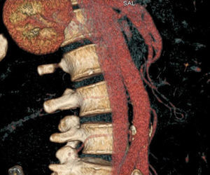 Disección de la arteria mesentérica superior en el paciente 3 (reconstrucción tridimensional).