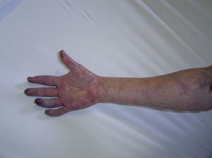 Se observa necrosis en la porción distal de la segunda falange del cuarto dedo de mano derecha, el resto de los dedos y antebrazo marmóreos. Nótese atrofia de falange distal de segundo dedo, secundaria a antecedente de trombosis humeral.
