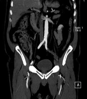 Angio-TAC: Oclusión de la arteria ilíaca externa izquierda.