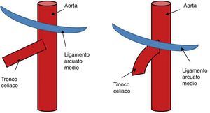 Representación esquemática de la variación de la posición del ligamento arcuato medio en relación con el tronco celiaco, superior o anterior.