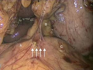 Imagen laparoscópica de liberación laparoscópica de ligamento arcuato. A: arteria hepática. B: arteria gástrica izquierda. C: arteria esplénica. Flechas: ligamento arcuato.