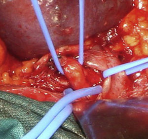 Liberación quirúrgica del tronco celiaco. Bandas de silicona: arteria hepática, arteria esplénica y ligamento arcuato.