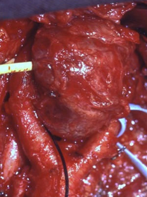 Tumor del glomus carotídeo (Shamblin tipo II). Impronta de la bifurcación carotidea en polo inferior de quemodectoma.