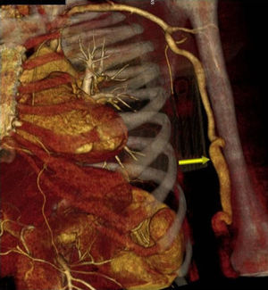 AngioTC donde se observa la dilatación y torsión de la arteria humeral.