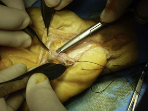 Disección y control proximal y distal de pseudoaneurisma de la arteria cubital.
