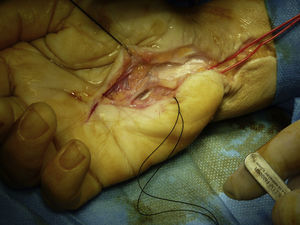 Arteria cubital reparada tras exclusión del pseudoaneurisma.