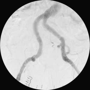 Arteriografía de control post-implantación: permeabilidad de aorta infrarrenal y ambos ejes ilíacos sin estenosis significativas.