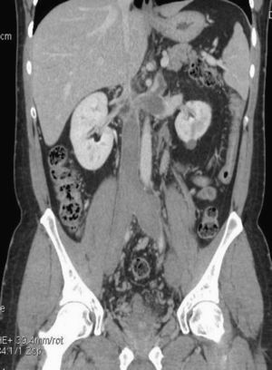 TC abdominal con contraste, corte coronal. Agenesia de vena cava inferior suprarrenal. Trombosis de vena renal izquierda, cava infrarrenal y ambas ilíacas.