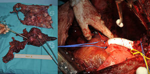 Pleurectomía derecha y timectomía (la pinza de la derecha muestra la vena cava superior extirpada). Reconstrucción de la vena cava superior con prótesis de PTFE anillada n° 16 (anastomosis término-terminal).