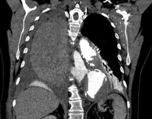 Tomografía computarizada de tórax: corte coronal que muestra aorta torácica descendente aneurismática con paredes calcificadas, fuga de contraste hacia hemitórax derecho y derrame pleural bilateral con colapso pulmonar de predominio derecho.