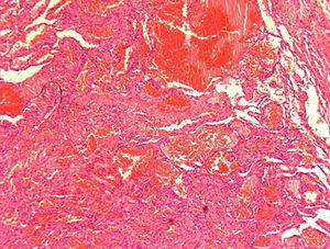 Anatomía patológica mediante tinción de hematoxilina-eosina a 10×. Se observa un patrón sólido y fusiforme de núcleos monomorfos con canales vasculares en su interior.