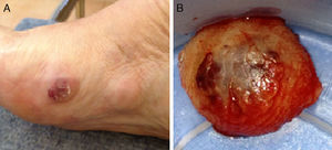 A) Lesión nodular dolorosa localizada en región posterolateral de primer dedo de pie derecho. B) Imagen de la pieza quirúrgica.