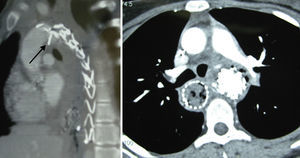 TC con contraste i.v. Izquierda: perforación de la aorta por stent libre (flecha). Derecha: mediastinitis con burbujas de gas en mediastino y stent esofágico.
