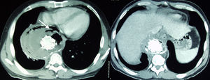 TC con contraste i.v. Cortes transversales. Izquierda: comunicación entre el saco aneurismático y el esófago (flecha). Derecha: burbujas de gas en saco aneurismático y mediastino a nivel de torácico distal.