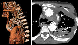Izquierda: angio-TC en reconstrucción 3D, endoprótesis aórtica con zona de anclaje proximal en la aorta ascendente, bypass desde aorta ascendente a tronco braquiocefálico y bypass carótido-carotídeo, Amplatzer en origen de subclavia izquierda. Derecha: derrame pleural y mediastinitis con drenaje pleural y mediastínico (flechas).