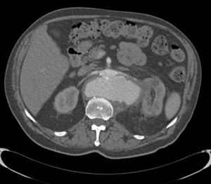 Angio-TC: seudoaneurisma sacular de la pared posterior de aorta abdominal suprarenal de 13×11×11,5cm.