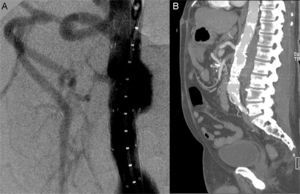 Angiografía peroperatoria (A), angio-TC al mes (B). Correcta colocación de la endoprótesis enrasada distal a tronco celíaco, sin apreciarse endofugas y con bypass viscerales permeables.