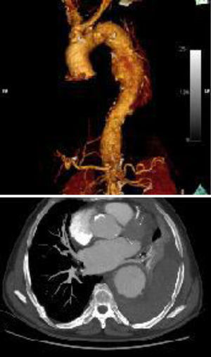 Arriba: reconstrucción 3D de aneurisma de aorta abdominal. Abajo: corte transversal que muestra masivo hemotórax masivo izquierdo.