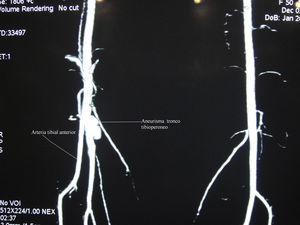 Angiorresonancia magnética de extremidades inferiores: véase aneurisma de tronco tibioperoneo derecho, bilobulado, con salida atípica de arteria tibial anterior.