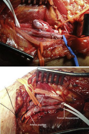 En la parte superior se aprecia el aneurisma de tronco tibioperoneo una vez disecado. En la parte inferior vemos el resultado tras la reparación quirúrgica.