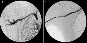 Arteriografía intraoperatoria. A) Rotura de la arteria axilar. B) Resultado final tras la colocación del stent recubierto.