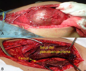 A) Exposición del saco del seudoaneurisma. B) Abordaje de la arteria femoral profunda con exposición del tercio medio del fémur y pared del saco del seudoaneurisma ya abierto.