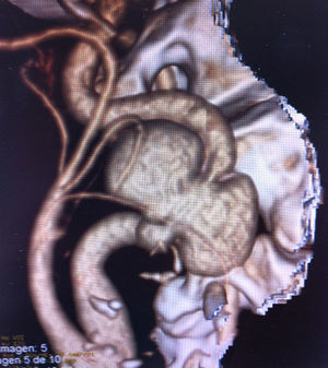 Imagen de la angio-TC diagnóstica en la que se observa el seudoaneurisma micótico en la arteria carótida interna.
