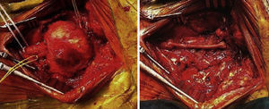 Imagen del seudoaneurisma carotídeo y del bypass carótido-carotídeo a la arteria carótida interna con vena safena interna invertida tras resección del seudoaneurisma.