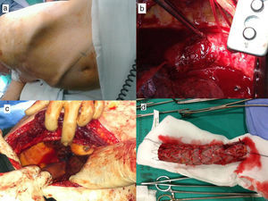 Bypass axilar derecho-femoral izquierdo de descarga (a), zona de drenaje del empiema de aorta torácica abierto tras realizar arteriotomía (b), bypass aortoaórtico con prótesis Dacron plata (c) endoprótesis Valiant Captivia de 30×30×157mm, tras el explante (d).
