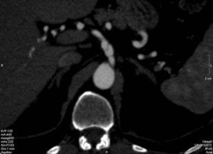 Angio-TC de abdomen, corte axial con reconstrucción MIP: dilatación aneurismática del tronco celíaco con disección.