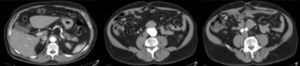 Angio-TC abdominal (cortes axiales). Aneurisma de aorta abdominal infrarrenal de 45mm y masa preaortoilíaca de 40mm.