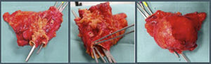 Pieza quirúrgica. Segmento de aorta abdominal infrarrenal con luz dilatada rodeada por una tumoración nodular de bordes regulares con un tamaño de 8×7×5cm.