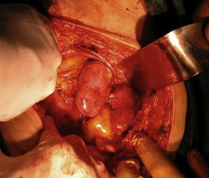 Cirugía de implante. Anastomosis terminolateral de la aorta y cava del donante a los vasos ilíacos externos del receptor.