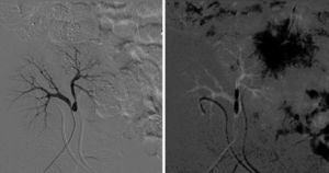 Estenosis bilateral de las arterias renales del donante, resuelta con angioplastia simple.